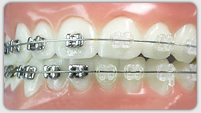 Types of Braces Art of Orthodontics